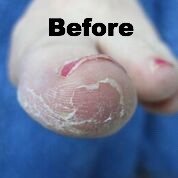 footlogix 7 peeling skin formula 125ml