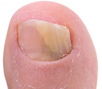 opleiding mycose maandag 26 januari 2026 10h00 tot 13h00